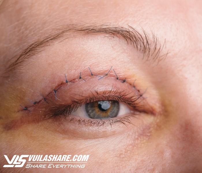 Học bí kíp chăm sóc sau cắt mí mắt từ chuyên gia- Ảnh 1.