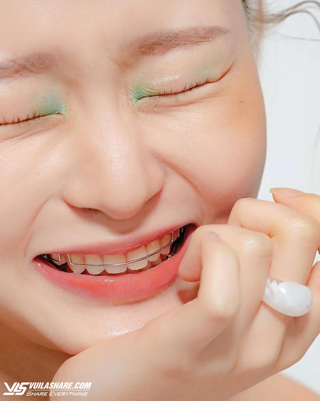 Chăm sóc hàm duy trì sau khi niềng răng hiệu quả nhất từ nha sĩ- Ảnh 2.