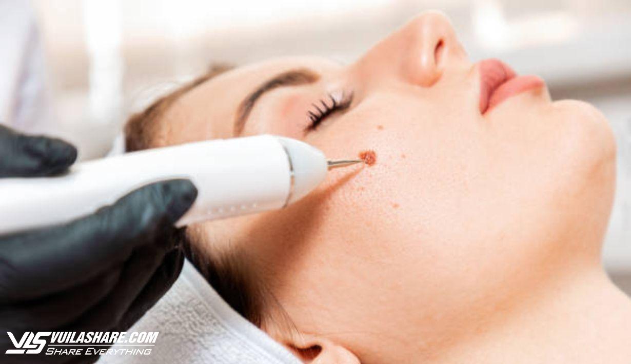 Cách chăm sóc vết thương sau điều trị laser nốt ruồi để ngăn ngừa sẹo- Ảnh 1.