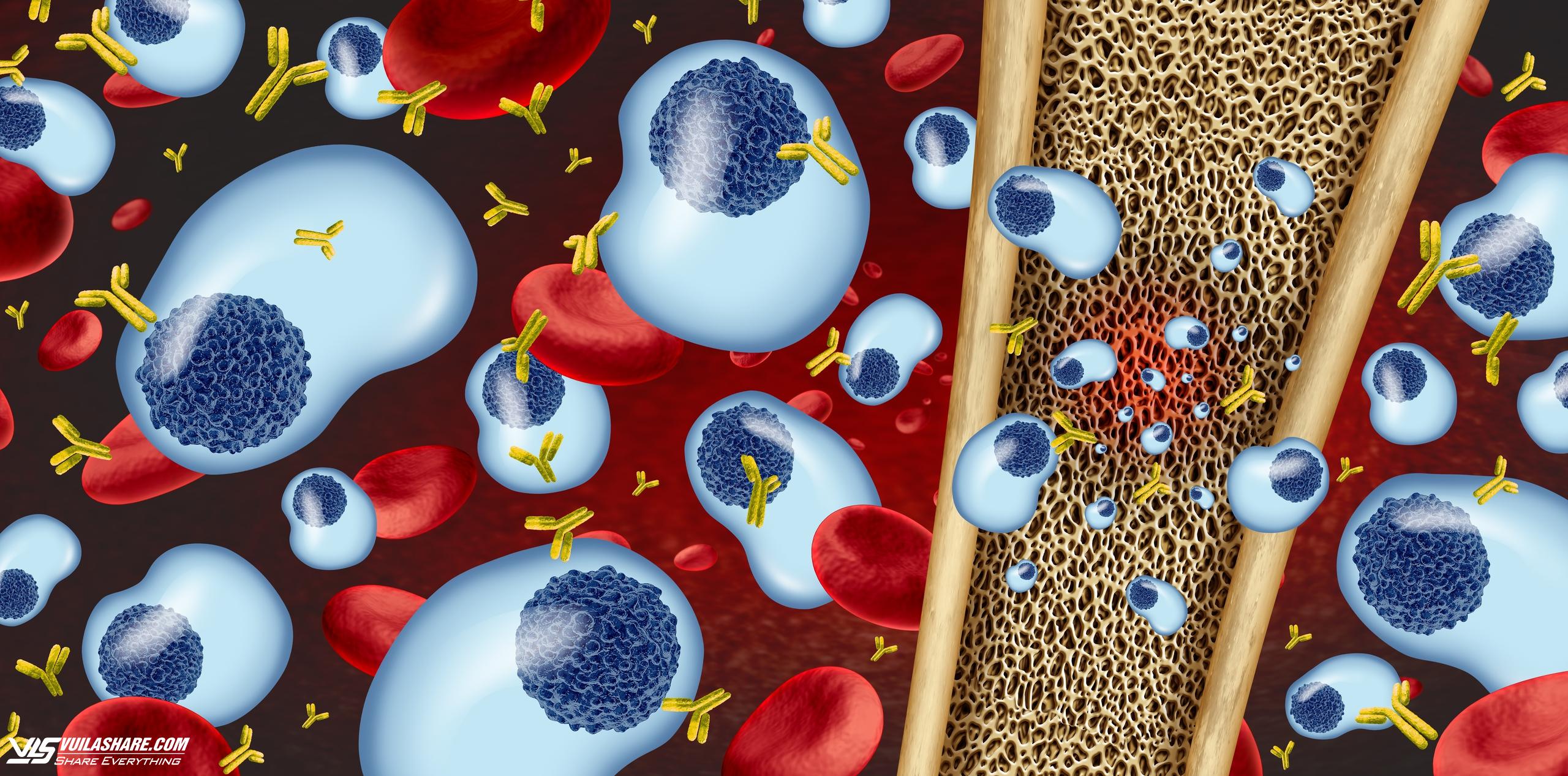 Bệnh đa u tuỷ xương gây ra do rối loạn tế bào plasma (màu xanh), hình thành các ổ tiêu xương. Nguồn ảnh minh hoạ: Shutterstock